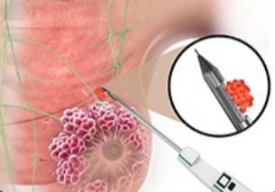 Biopsy