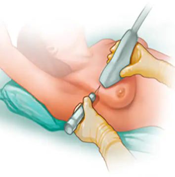 Core Needle Biopsy