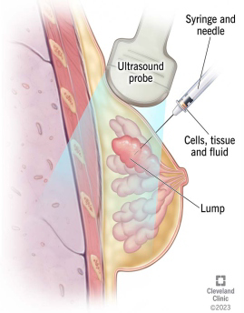 FNA Biopsy