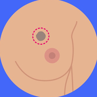 Lumpectomy