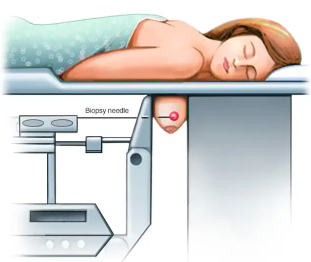 Stereotactic Biopsy